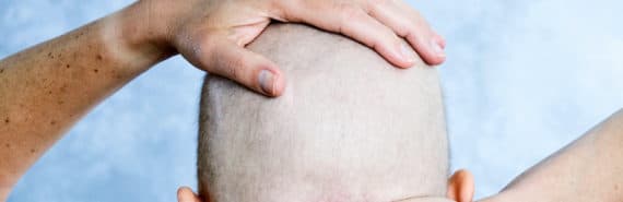 cancer patient with hand on head