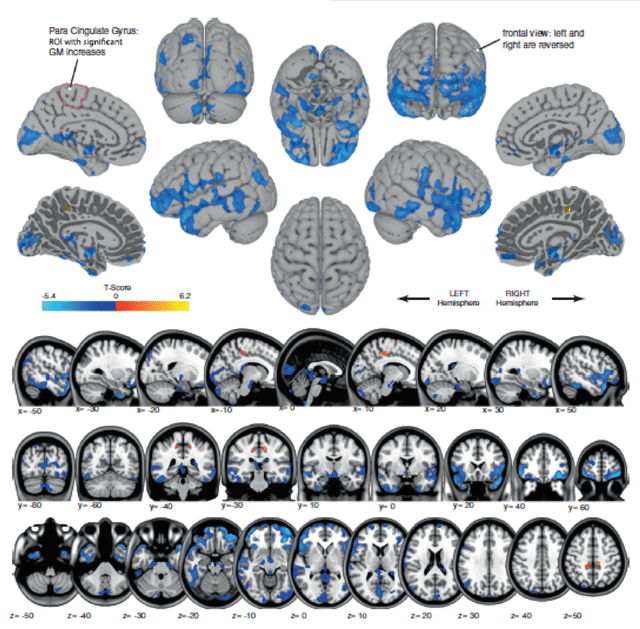 brain changes in astronauts