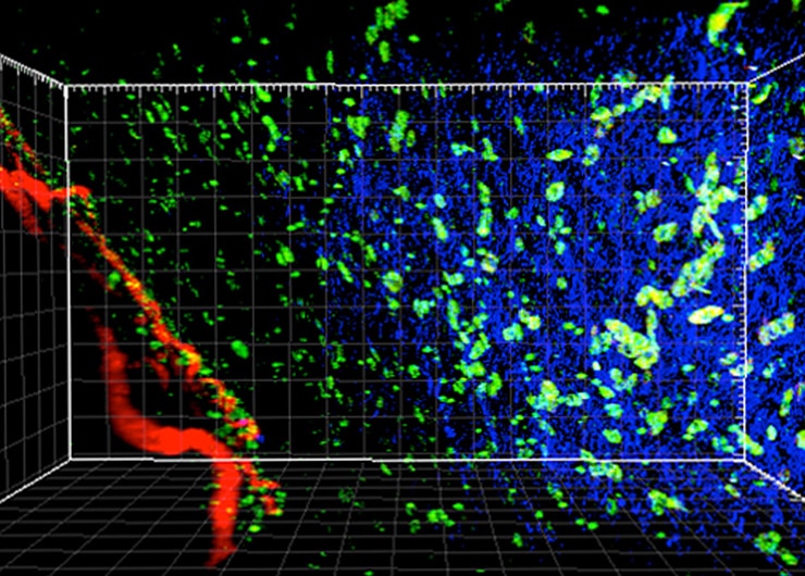 3D microscopic view of tumor