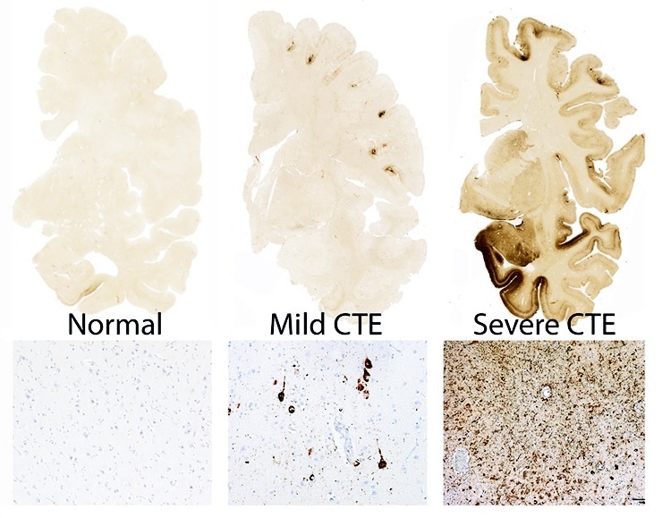 CTE images