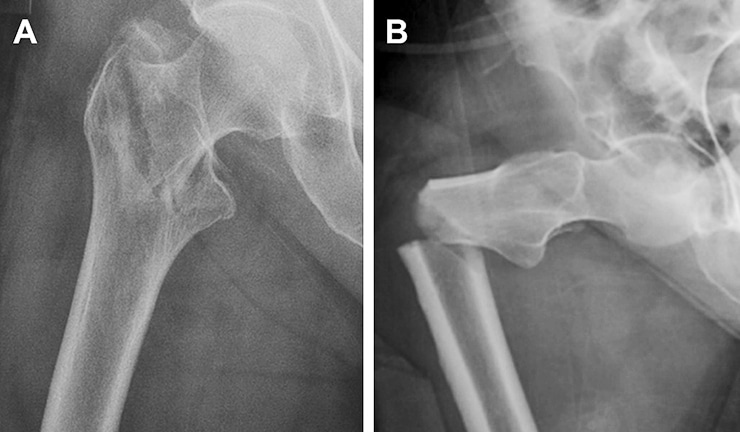 radiograph images showing fractures