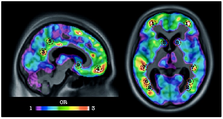 amyloid brain scan