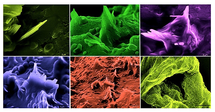 cholesterol crystals