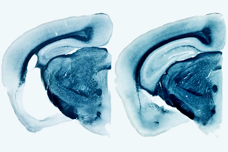Alzheimers brain comparison