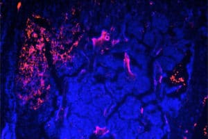 metastatic breast cancer