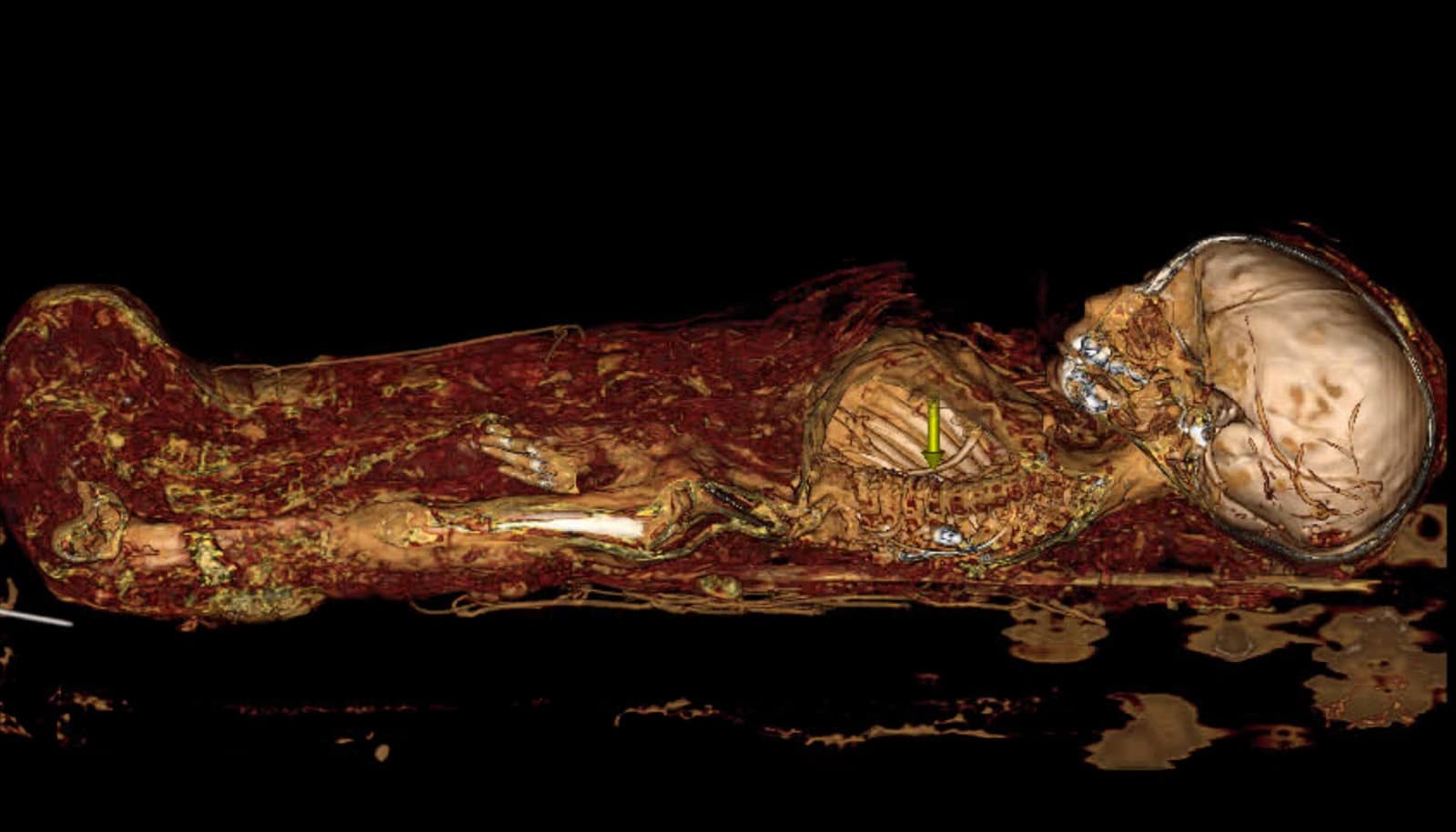 CT scan of baby mummy