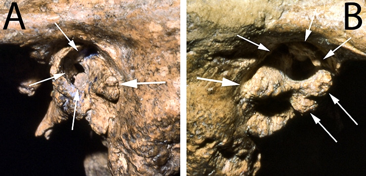 Shanidar 1 skull