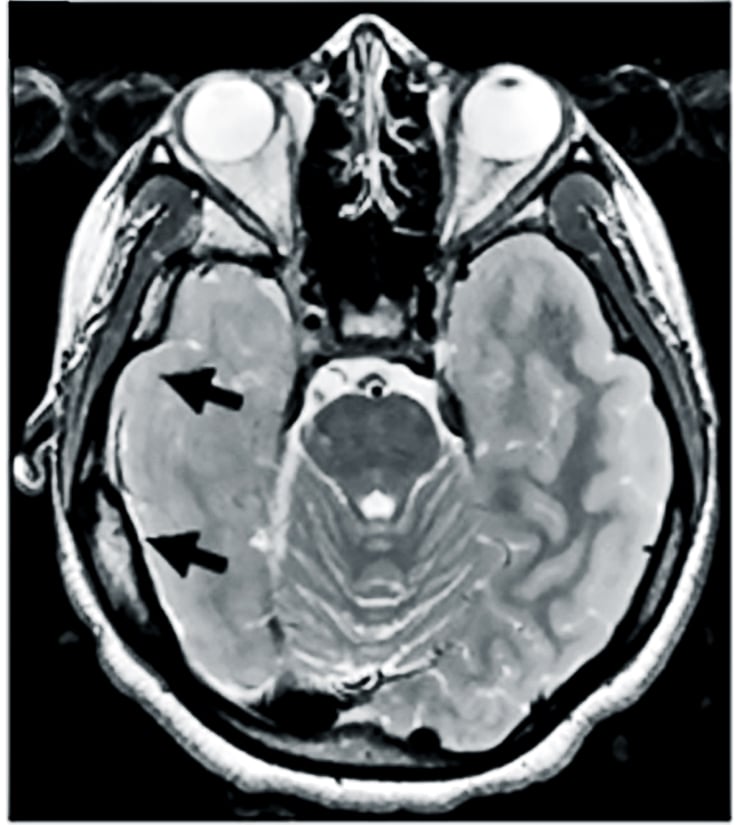 epilepsy brain scan
