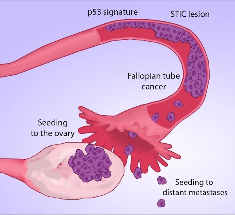 fallopian tubes diagram