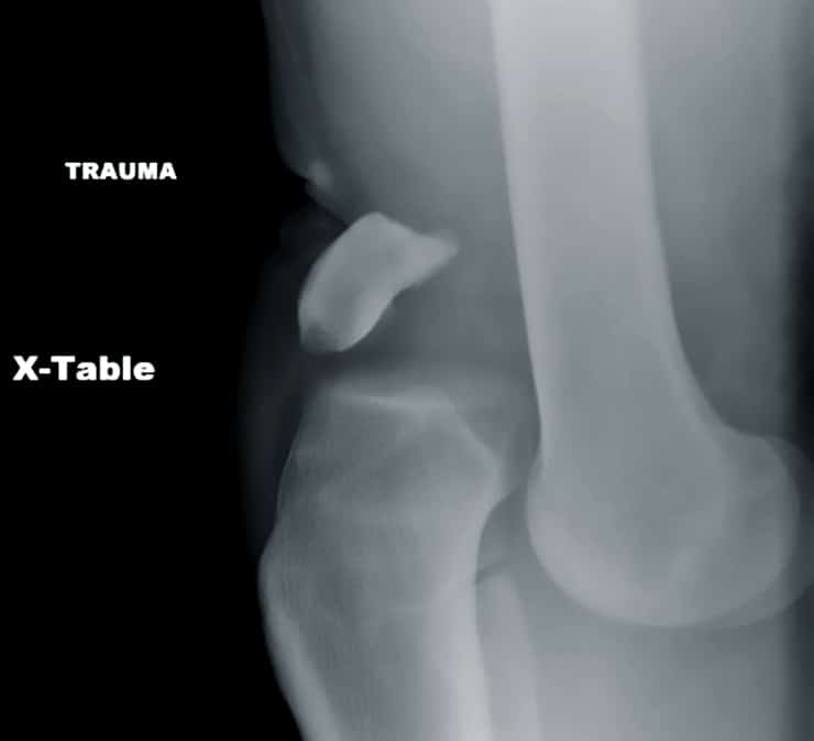 knee dislocation x-ray