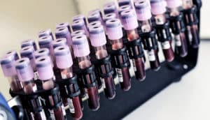 blood samples in vials (multiple myeloma/blood cancer concept)