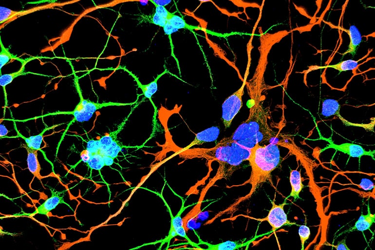 Huntington's neurons