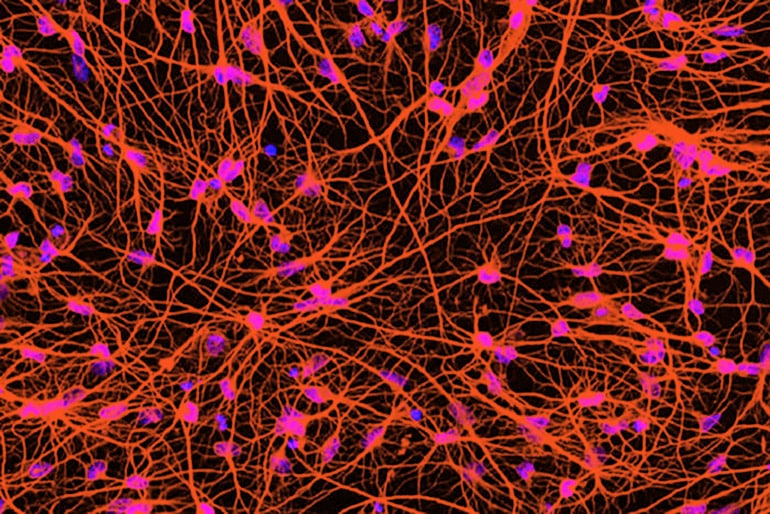 Huntington's disease cells