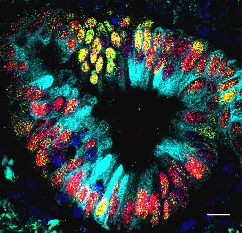 lung tumor also includes cells characteristic of the duodenum and intestine