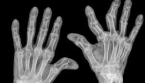arthritis hands x-ray