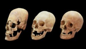 deformed, intermediate, and normal skulls
