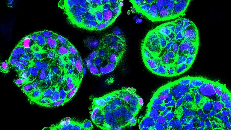 HCC organoids in culture