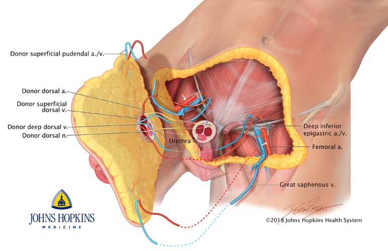 penis and scrotum transplant