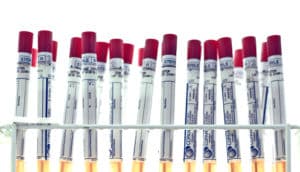 swabs in rack - cervical cancer screening