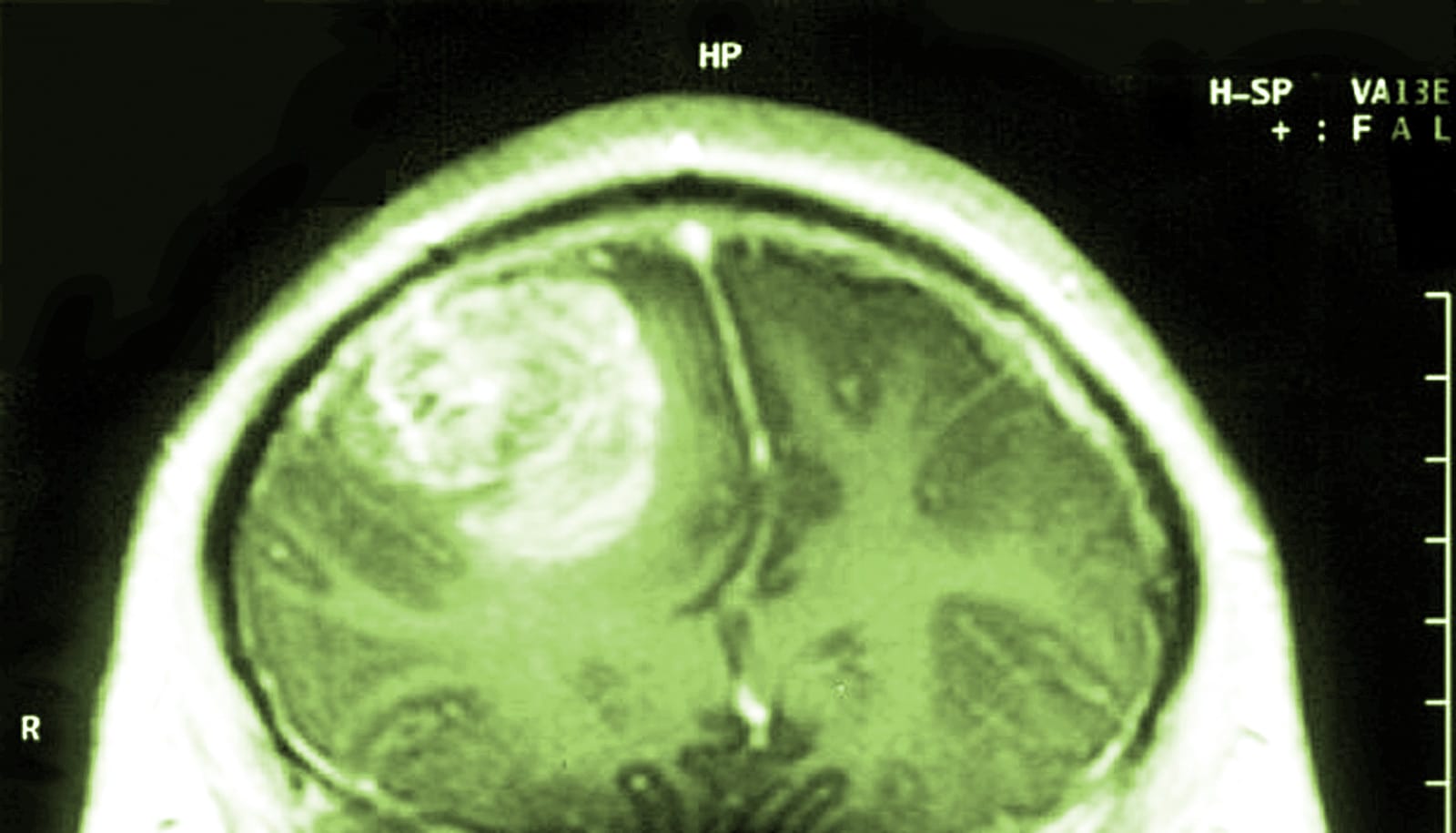 Poliovirus can extend survival with glioblastoma Futurity