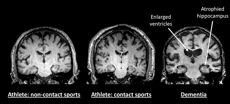 brain comparison (early onset dementia concept)