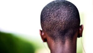 back of kid's head (neurofibromatosis type 1 concept)