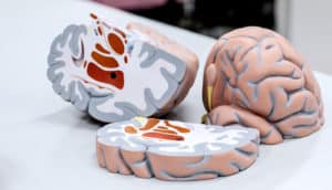 brain in pieces (ALS concept)