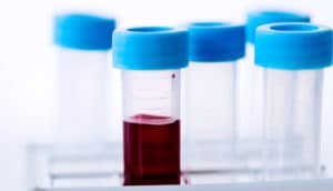 blood vials against white (myeloma concept)