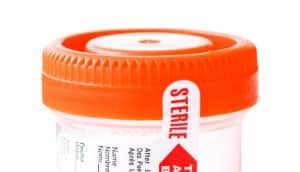 urine test cup (multiple sclerosis concept)