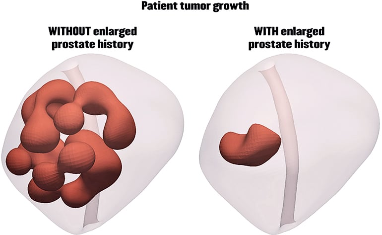 enlarged prostate simulation