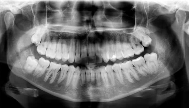 xray of jaw and teeth