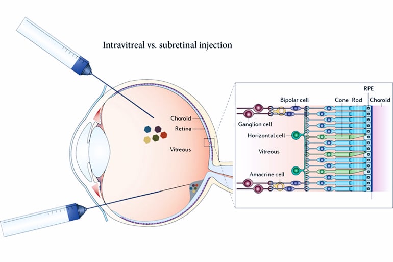 Intravitreal injection