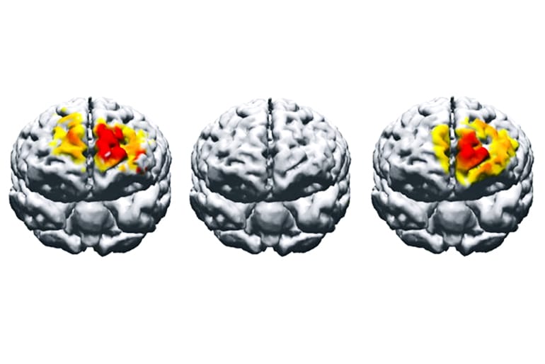 electrostimulation brain comparison