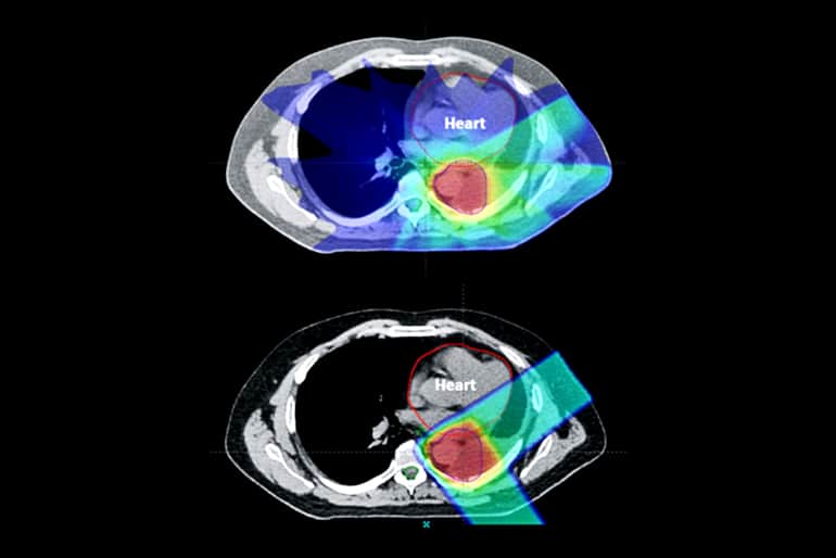 proton therapy vs. x-ray radiation therapy