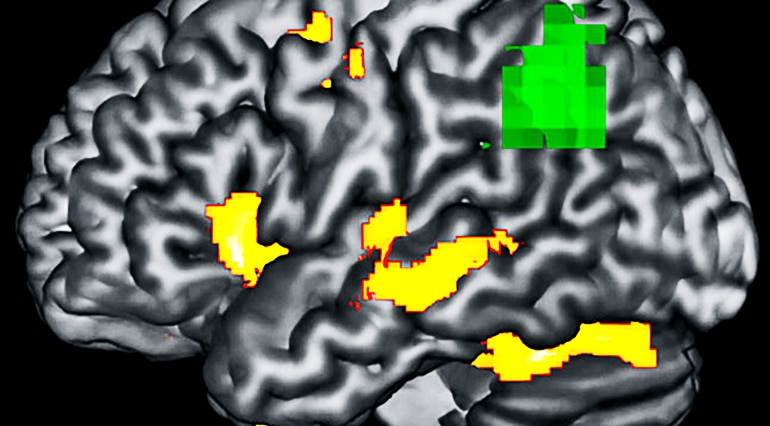 PPA brain imaging
