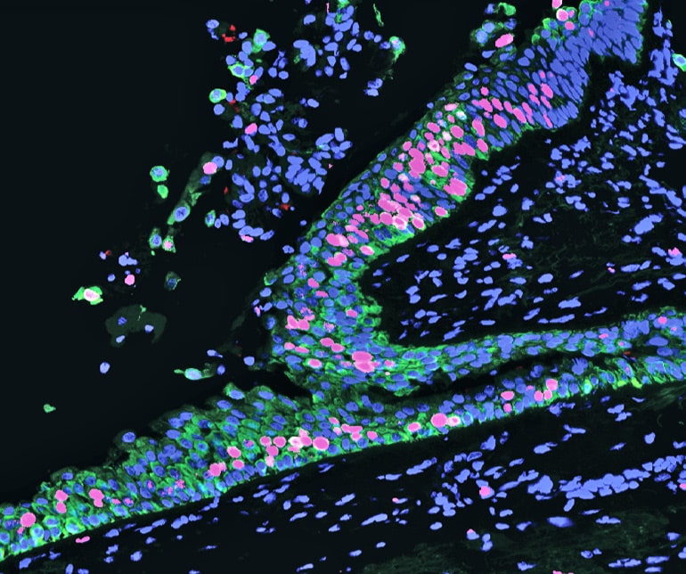 precancerous lung tissue