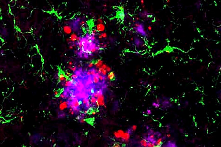 amyloid plaques surrounded by immune cells called microglia and tau protein (Alzheimer's disease concept)