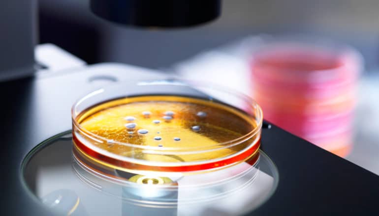 antiphospholipid syndrome - orange petri dish on microscope