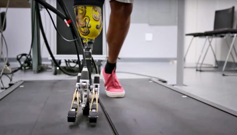 person using prosthetic tripod foot on treadmill