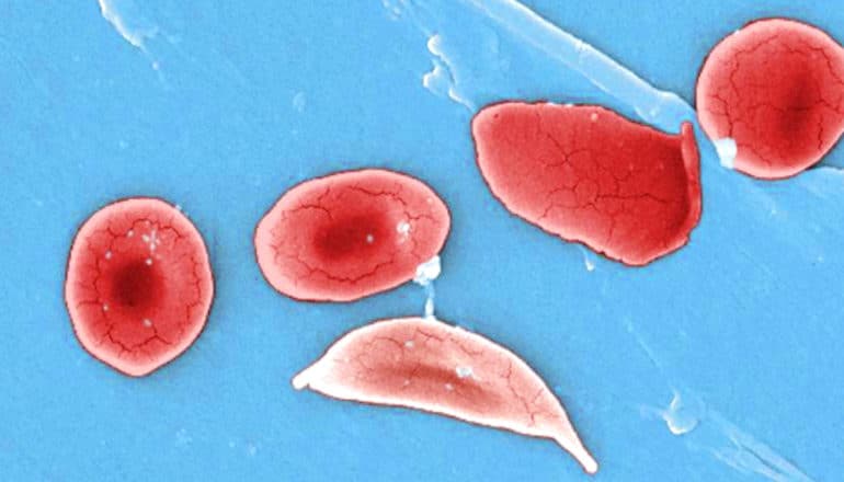 sickle cell disease - regular and sickled red blood cells