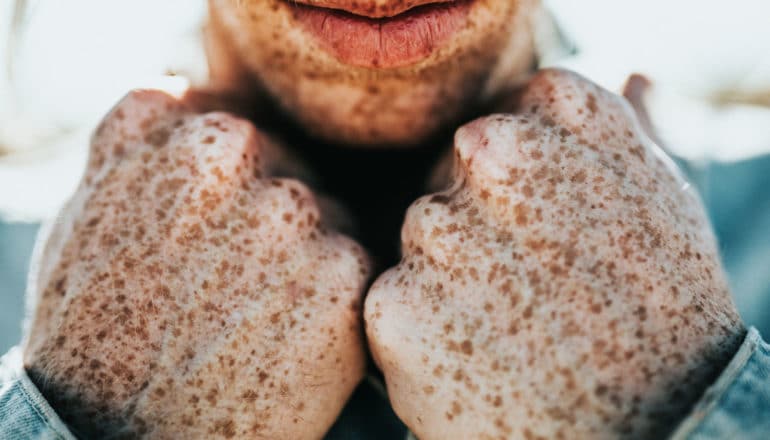 freckled hands under chin - virtual biopsy