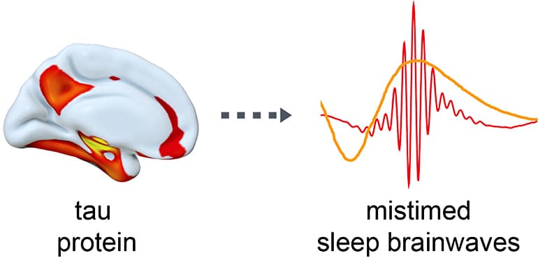 Tau in the brain and sleep brainwaves