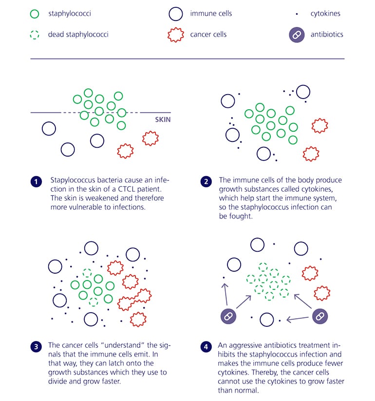 antibiotics lymphoma infographic (CTCL concept)