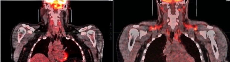 Two heat-map style images of bodies with color indicating activity in brown fat