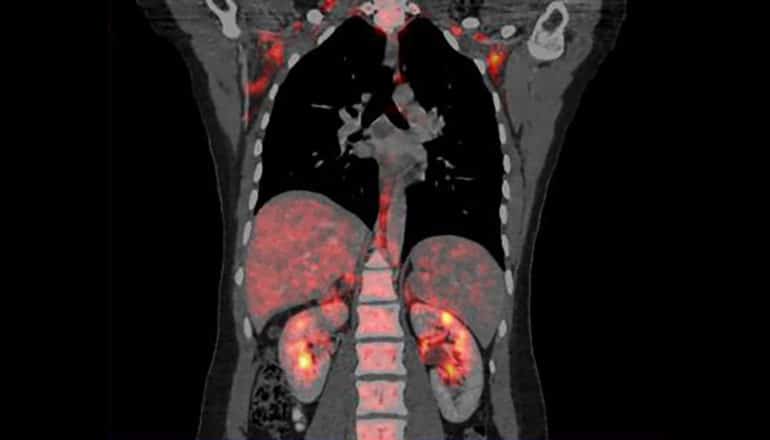 brown fat is pink-red on PET scan of human torso