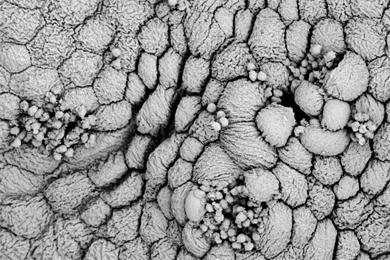 Blob-looking white blood cells surround groups of smaller bladder cells