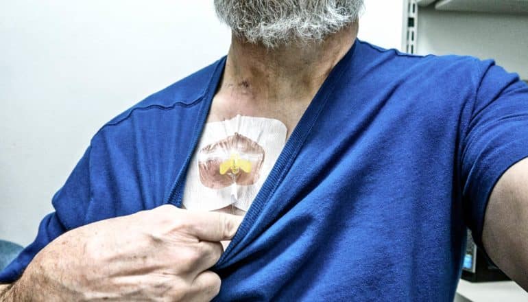 person pulls down shirt to reveal chest port for chemotherapy