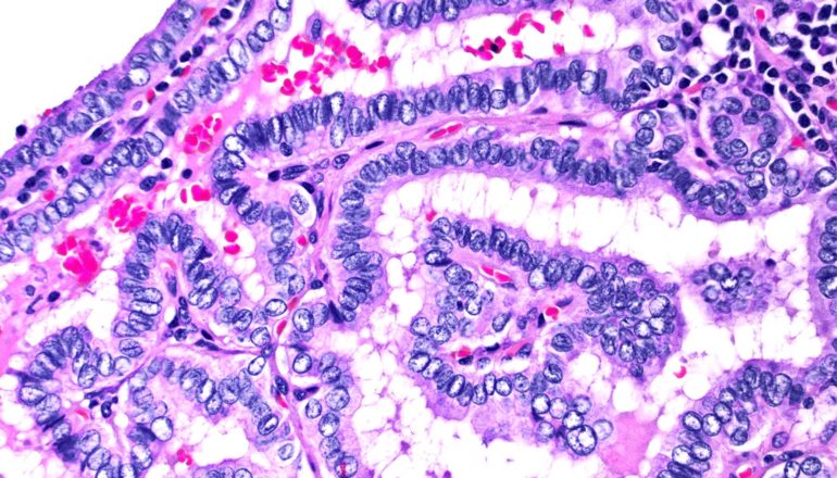 Thyroid cancer cells show up purple against a white background