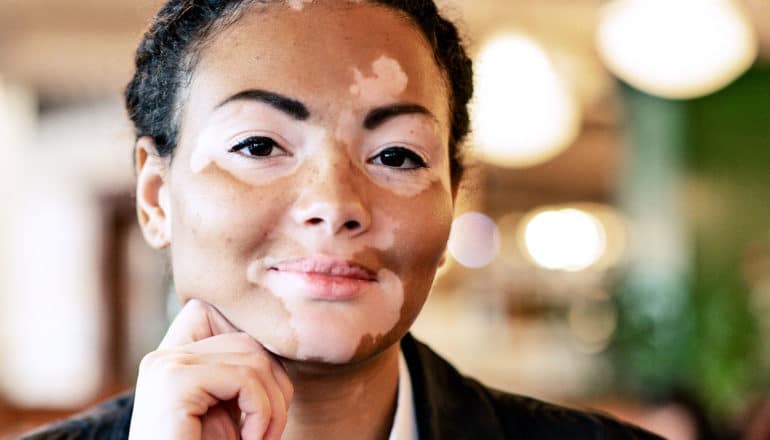 A woman with Vitiligo sits in a cafe with her hand on her chin