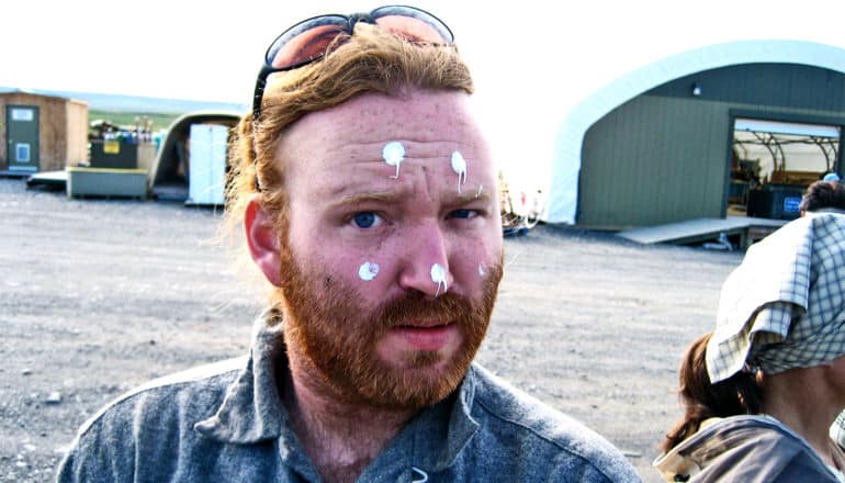 A red-haired, fair-skinned man has dots of white sunscreen on his sunburned face